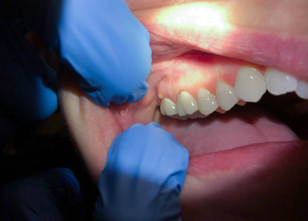 Best Emergency Cosmetic Dentistry (e.g., broken veneers) in Portola Valley, CA