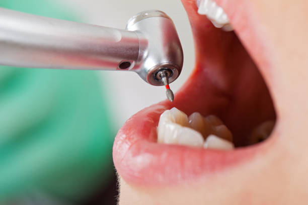 Best Emergency Wisdom Tooth Extraction in Portola Valley, CA